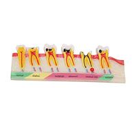 Modello di Denti, Modello di Sviluppo della Carie Dentale Modello Portatile di Denti Cariati per lo Studio Dell'insegnamento Dentale, Modello Anatomico di Carie Dentale