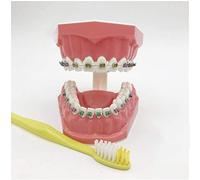 Modello Di Denti Per La Formazione - Modello Ortodontico - Modello Di Insegnamento Dei Denti Con Staffa In Metallo E Ceramica - Modello Di Formazione Correttiva Dei Denti Per L'insegnamento Dell'igien