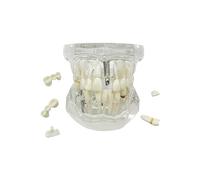 Modello di denti per malattie trasparenti, YOUYA DENTAL Trasparente Impianto Dentale Modello Dentista Malattia standard Dente rimovibile Modello di insegnamento patologico
