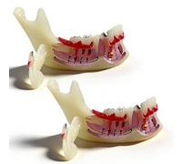 Modello di denti Typodont per l'educazione orale, strumento dimostrativo per lo studio della carie e della cisti radicale, aiuto didattico anatomico per dentisti