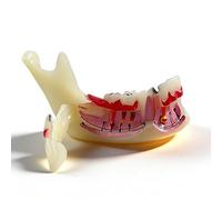 Modello di denti Typodont per l'educazione orale, strumento dimostrativo per lo studio della carie e della cisti radicale, aiuto didattico anatomico per dentisti