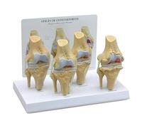 Modello di Ginocchio osteoartrosico, Modello di malattia articolare degenerativa, Modello anatomico per studi Medici e aule