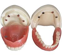 Modello di impianti dentali, modello di protesi dentale staccabile, overdenture a bocca piena con 4 impianti demo per l'insegnamento scolastico, lo studio, la dimostrazione
