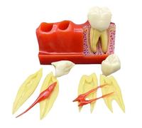 Modello di Impianto Dentale 4 Volte - Modello di Impianto per Studio Dentistico - per Analisi Odontoiatriche E Didattiche di Laboratorio