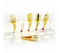 Modello di impianto dentale per l'educazione del paziente, modello di trattamento endodontico/dimostrazione di anatomia del canale radicolare, modelli di denti per la didattica in laboratorio
