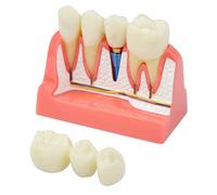 Modello di impianto dentale Ponte a corona rimovibile 4 volte Impianto for studio stutent, dimostrazione didattica ed educazione del paziente