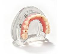 Modello di impianto e restauro Dentale, protesi mobile mandibolare con 4 impianti,Modello dimostrativo di Ponte implantare di restauro Rimovibile Inferiore in Gomma siliconica