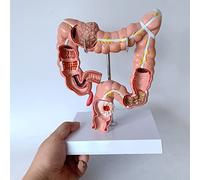 Modello di lesione colorettale - Anatomia patologica per l'insegnamento medico e la dimostrazione delle malattie del colon
