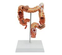 Modello di Malattia Del Colon Modello di Lesione Viscerale Modello di Patologia Del Colon Umano Modello Intestino Crasso Strumento di Apprendimento per L'Insegnamento Medico