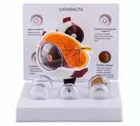 Modello di occhio con cataratta, modello di occhio, modello anatomico del bulbo oculare con visualizzazione della cataratta, for l'anatomia umana, studio degli studenti di scienze dell'educazione