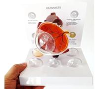 Modello di Occhio di Cataratta, Replica di Un Occhio con Condizioni di Cataratta per L'anatomia Umana E L'educazione alla Fisiologia, Modello Anatomico per L'Ufficio del Medico E Le Aule