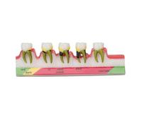 Modello di parodontite dentale, modello tipodontico per parodontite, strumento di allenamento dentale per illustrare le fasi parodontite e le tecniche di trattamento