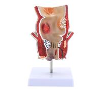 Modello di patologia del retto umano, strumento didattico per