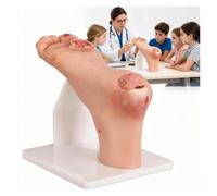 Modello Di Patologia Dell'ulcera Del Piede Diabetico, Design Dall'aspetto Realistico E Altamente Simulato, Simulatore Infermieristico Con Lesioni Purulente(Severe)