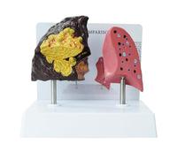 Modello di polmone di fumatore + modello di polmone sano, modello 3D a grandezza naturale 1:1, con caratteristiche patologiche e struttura anatomica precisa, for dimostrare gli effetti del fumo sulla