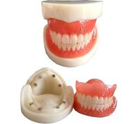 Modello di Protesi Dentale - Modello di Studio Modello di Impianto di Adsorbimento Magnetico per Protesi Totale Modello di Denti - Modello Educativo per Denti Dentali - per L'educazione del