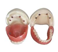 Modello di protesi dentale staccabile, overdenture a bocca piena