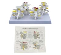 Modello di scheletro per anatomia della colonna vertebrale lombare a 4 stadi Lesioni Modello comparativo Vertebre Lombare Infermieristica Colonna vertebrale umana