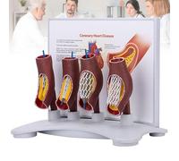 Modello di Stent per Blocco Dei Vasi Sanguigni, Modello di Stent Coronarico Umano, Modello Anatomico di Stent Vascolare, Modello Dimostrativo di Allargamento Dei Vasi per La Didattica Medica