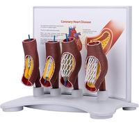 Modello di stent vascolare, dimostrazione dell'ingrossamento dei vasi sanguigni, modello di stent coronarico umano, modello di blocco vascolare, for la formazione medica