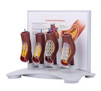 Modello di stent vascolare, modello vascolare umano, dimostrazione dell'ingrossamento dei vasi sanguigni, modello di blocco vascolare, modello di anatomia vascolare patologica, per l'insegnamento, for