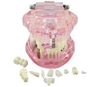 Modello di tipodonte dentale, impianto di restauro, modello di dente, analisi della patologia, ponte dentale, corona, insegnamento, studio, educa