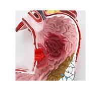 Modello di Torso Umano Modello di Lesione Gastrica Umana Modello Anatomico Medico Modello di Anatomia dello Stomaco per