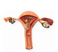 Modello di utero patologico, modello anatomico dell'apparato riproduttivo femminile, modello anatomico dell'utero e delle ovaie for l'educazione all'anatomia e alla fisiologia umana