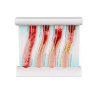 Modello di vasi sanguigni umani da 4 pezzi, modello anatomico vascolare dinamico, dimostra malattia arteriosa, accumulo di placca e viscosità del flusso sanguigno, for la ricerca medica