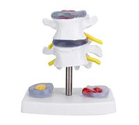 Modello di Vertebre Lombari Umane, Modello di Ernia del Disco Lombare Anatomico Umano con Base Staccabile Ottimo Modo per Dimostrare Il Disco