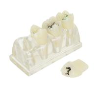 Modello Didattico dei Denti Cariati in ABS per Dimostrazione Orale | Comunicazione Paziente e Uso in Aula, Texture Realistica, Denti Cariati Staccabili, Studenti e Praticanti