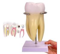 Modello Didattico Dentale con Ingrandimento 3X, Modello di Anatomia Dei Denti Della Carie Umana, Nervo Dentale Staccabile 6 Parti, Materiale PVC, per Visualizzazione, Insegnamento