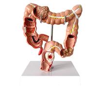 Modello educativo Modello anatomico dell'intestino crasso Umano Modello di patologia del Colon Modello di lesione viscer