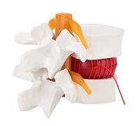 Modello Lombare Ernia del Disco Umano 1 1.5 Dimostrazione Medica Modello di Colonna Vertebrale Lombare Ernia del Disco Lombare Umano Modello Funzione Materiale Elastomero Morbido