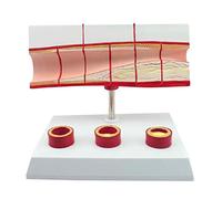 Modello Medico Della Malattia Coronarica - Modello Del Processo Di Trombosi - Modello Anatomico Del Cuore Umano - Modello Anatomico Medico Dell'organo Umano - Per Ausili Alla Formazione Medica Educati