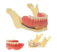 Modello orale dentale, modello di copertura della protesi mandibolare, modello di esposizione dell'unghia implantare con protesi rimovibile con nervi, for la ricerca, l'insegnamento e lo