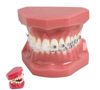 Modello ortodontico dentale - Staffe in metallo e ceramica per la comunicazione del paziente, ideale per dentisti e studenti di odontoiatria