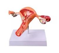 Modello patologico dell'utero e dell'ovaio - Aiuto didattico di anatomia riproduttiva femminile per l'educazione medica e dimostrazioni in aula