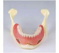 Modello Protesi Protesi per Restauro Implantare, Modello Mascella Anatomica Rimovibile, Modello Mandibola Overlay per Studio Dentale e Formazione