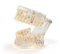 Modello trasparente di denti affetti da patologie con ponte implantare, modello tipodontico orale per la formazione di pazienti e studenti di odontoiatria.