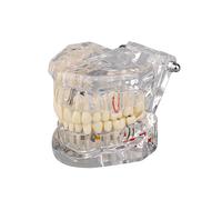 Modello trasparente di denti malati con ponte su impianto dentale, per l'istruzione di pazienti e studenti