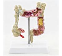 Modelo de patología de colon humano 1:2 con pólipos para enseñanza