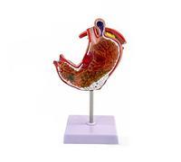 Modelo patológico de estómago grande con úlceras gastritis para enseñanza