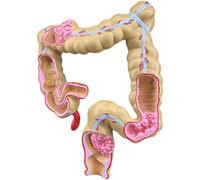 NZPOST Modello di Organo Umano Staccabile, Modello patologico del Colon Umano, Modello anatomico degli organi Interni per ausilio didattico