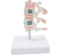 NZPOST Modello di osteoporosi Modello di Organo Umano Rimovibile per la Ricerca Medica Modello della Colonna Lombare Composizione vertebrale Descrizione