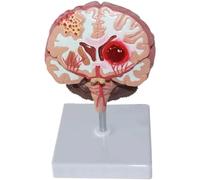 NZPOST Modello didattico colorato di Blocco vascolare cerebrale per Lo Studio educativo Modello di Anatomia patologica del Cervello MOD di Organo Umano