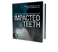 Orthodontic and Surgical Management of Impacted Teeth