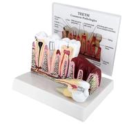 Patologie Comuni Modello del Dente, Sussidi Didattici per La Malattia della Carie, con Dente Staccabile, Display della Sezione Trasversale dei Denti, Modello Anatomico delle Gengive Dentali
