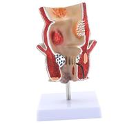 Patologie umane del modello di retto umano modello di rettale umano modello anatomico medico strumento didattico per l'insegnamento