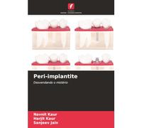 Peri-implantite: Desvendando o mistério